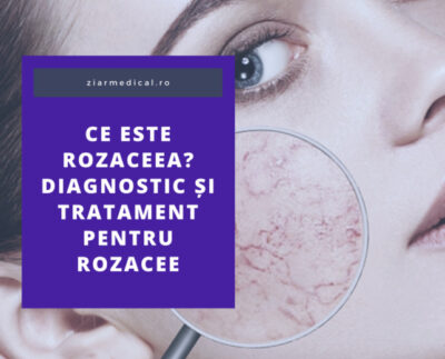 ce-este-rozaceea?-diagnostic-si-tratament-pentru-rozacee