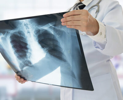 efectele-pe-termen-lung-ale-covid-19:-pacientii-vindecati-trebuie-monitorizati-pentru-ca-pot-ramane-cu-sechele-pulmonare