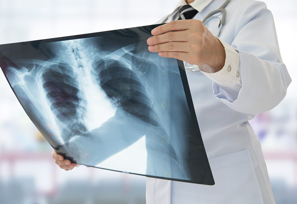 efectele-pe-termen-lung-ale-covid-19:-pacientii-vindecati-trebuie-monitorizati-pentru-ca-pot-ramane-cu-sechele-pulmonare